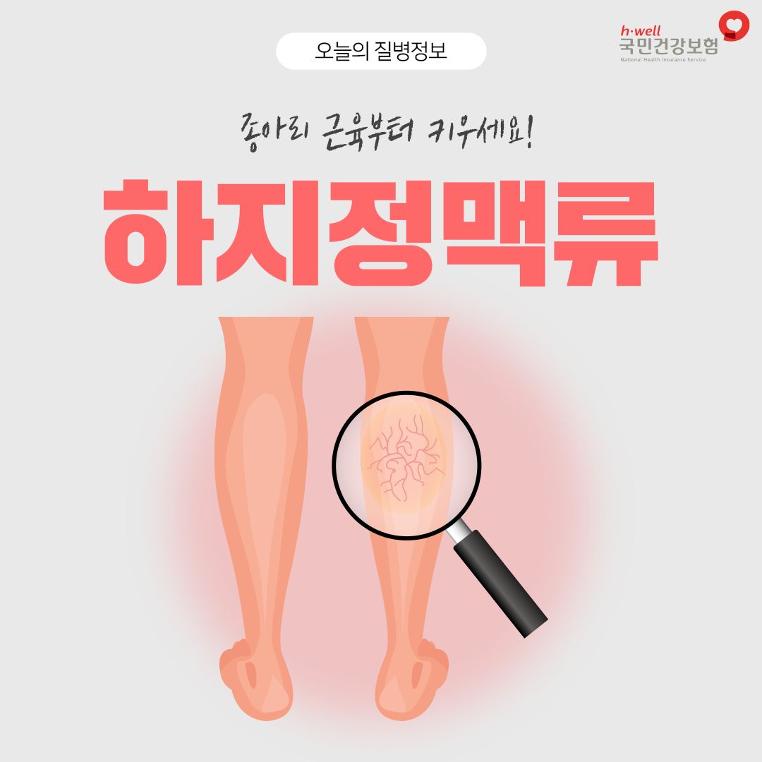 하지정맥류1.jpg